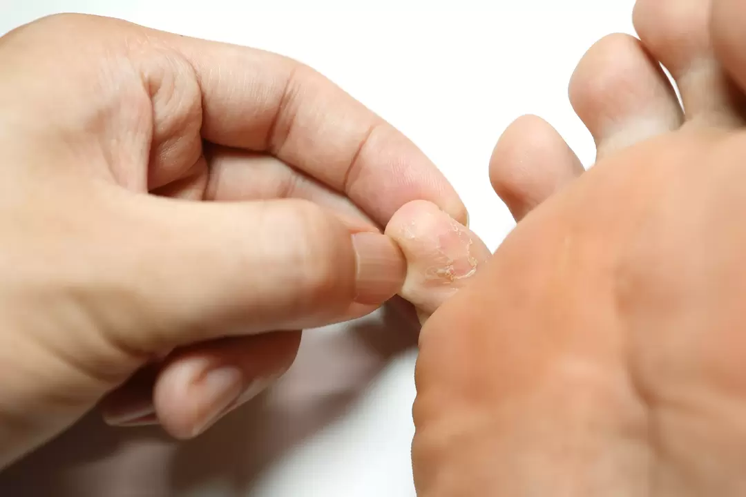 Huby na prstoch a jej ošetrenie krémom Zxcvbnmqwert s krémom