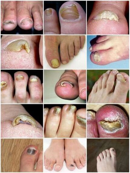 Plesňová infekcia nechtovej platničky
