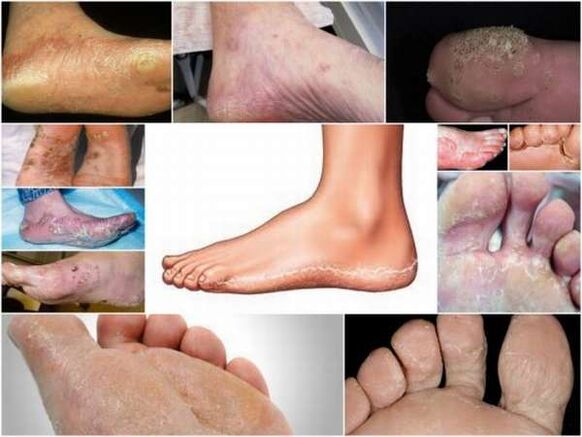 Skvamózno-hyperkeratotická forma mykózy nôh