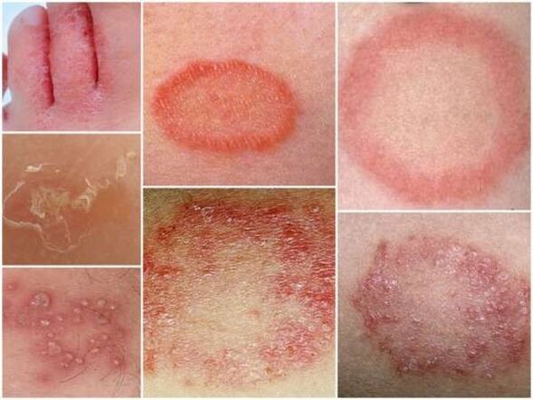 Trichofytóza kože nôh