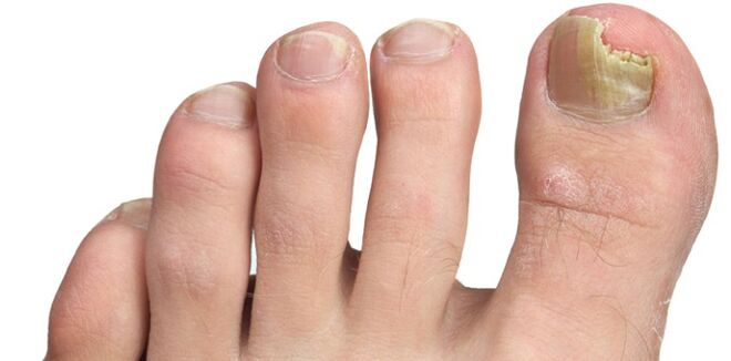 plesňová infekcia nechtovej platničky